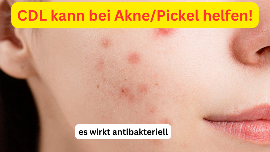 CDL Akne Pickel es wirkt antibakteriell