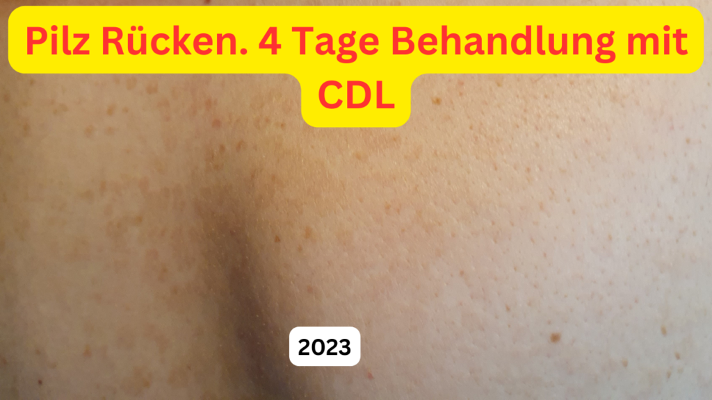 Rücken Schulter Pilz 4 Tage nach Behandlung mit CDL der Haut