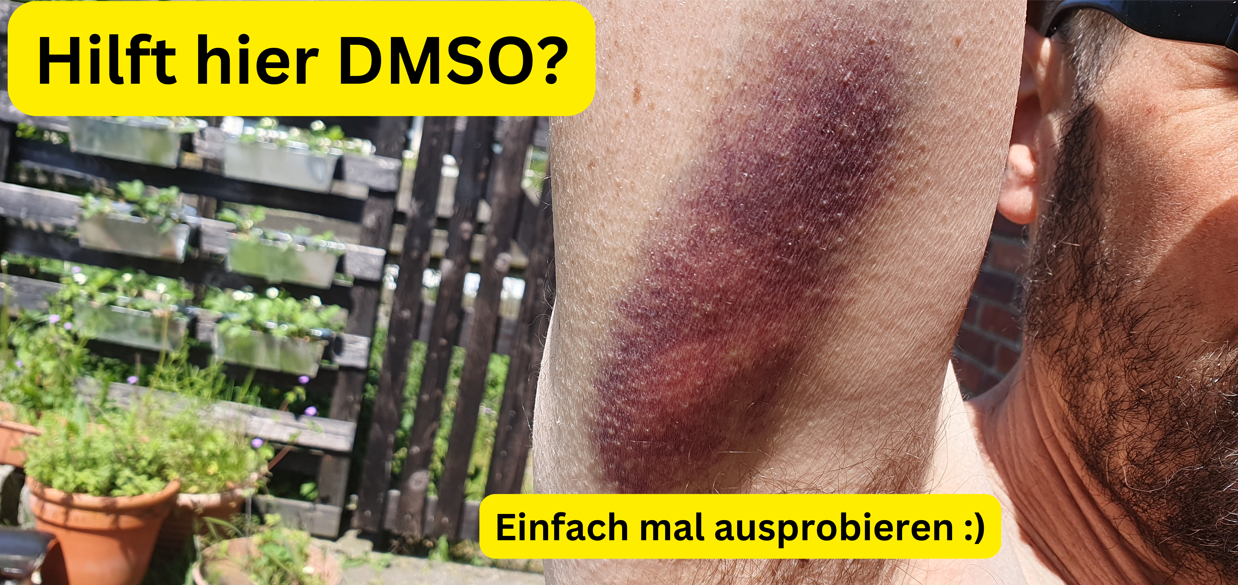 Hämatom Schwellung Prellung DMSO Sportverletzung Erfahrungen.