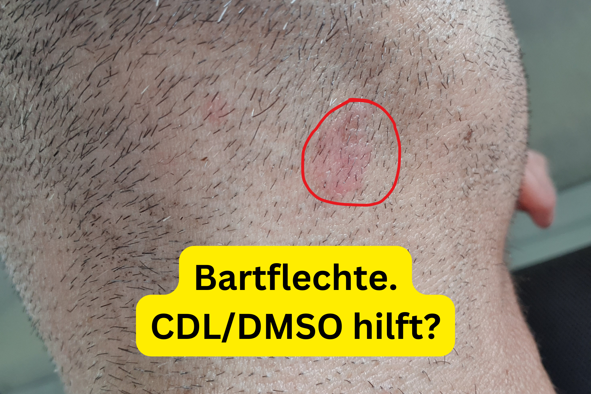 Bartflechte selbst behandeln mit CDL: Meine Erfahrungen mit Haarbalgentzündung